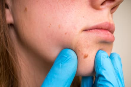 What Are Skin Tags? 